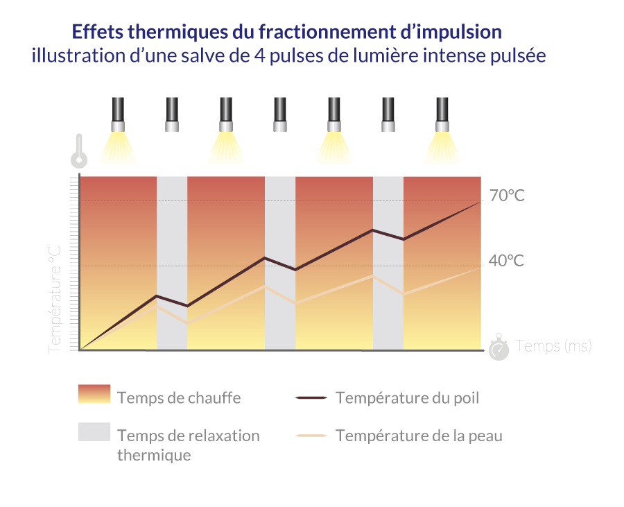 illustration de l'effet thermique du fractionnement d'impulsion de la lumière pulsée SHR